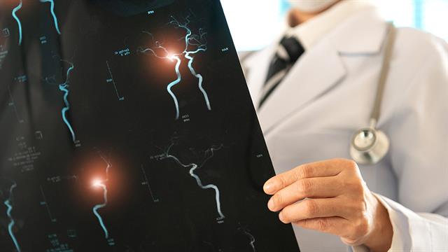 Γονιδιακός διακόπτης προστατεύει την αορτή από ανευρύσματα