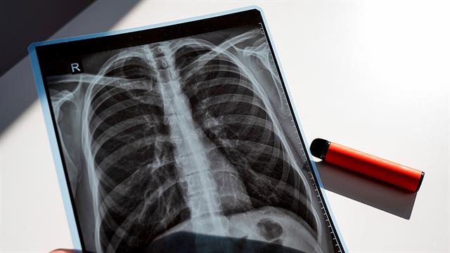 Εξατομικευμένος έλεγχος για τον καρκίνο του πνεύμονα σε πρώην καπνιστές [έρευνα]