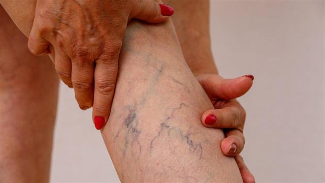 Το μέλλον στη θεραπεία κιρσών και φλεβικής ανεπάρκειας