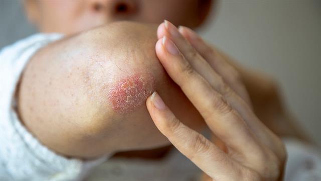 Ψωρίαση: Διαφορετικοί χρόνοι διακοπής θεραπείας με τα βιολογικά φάρμακα