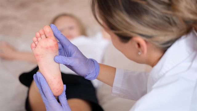 ECDC: Σημαντική μείωση κρουσμάτων ιλαράς - Παραμένουν διπλάσια από το 2023