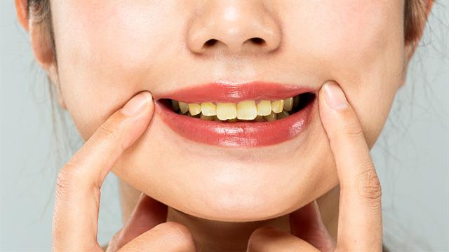 Χρωστικές και μείωση μεγέθους δοντιών: Πρόληψη και θεραπεία