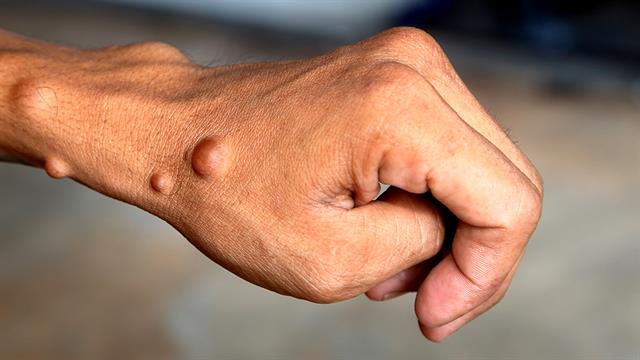 Πρόοδος στη Θεραπεία και Διαχείριση της  Νευροϊνωμάτωσης Τύπου 1 (NF1)