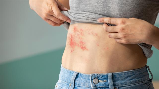 Έρπης ζωστήρ: 1 στους 3 ενήλικες θα νοσήσει