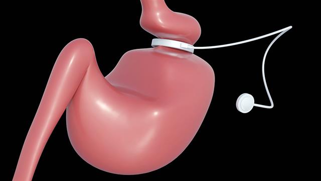 Γαστρικός δακτύλιος: Γιατί πρέπει να αφαιρείται