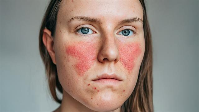 Ερυθηματώδης λύκος: Ενδοφλέβιο φάρμακο μείωσε τα συμπτώματα σε κλινική δοκιμή