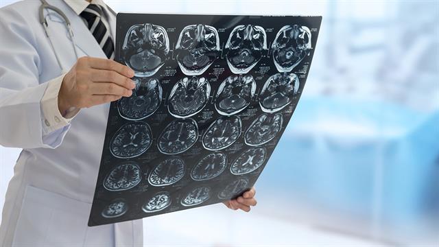 Πώς βελτιώνεται η έκβαση της υγείας  ασθενών με οξύ εγκεφαλικό επεισόδιο