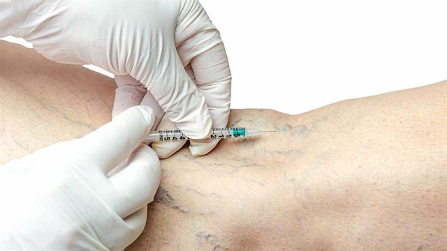 Σκληροθεραπεία: Μια αξιόπιστη λύση για την εξάλειψη των ευρυαγγειών