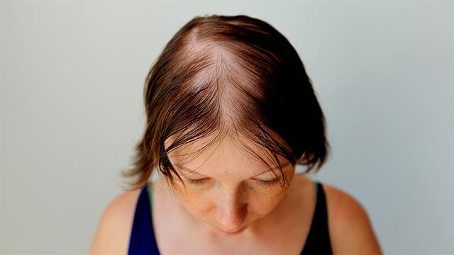 Μπορεί το στρες να προκαλέσει τριχόπτωση;