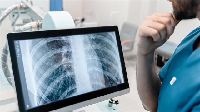 Φυματίωση - ECDC: Αδιάγνωστο 1 στα 5 κρούσματα στην Ευρώπη - Τι γίνεται στην Ελλάδα