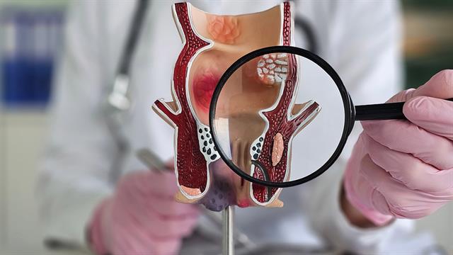 Πρώτος αναστολέας checkpoint για τον καρκίνο του πρωκτού