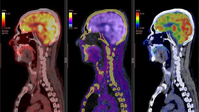 Η Πυρηνική Ιατρική στην Ογκολογία: Νέα ραδιοφάρμακα για διάγνωση και θεραπεία