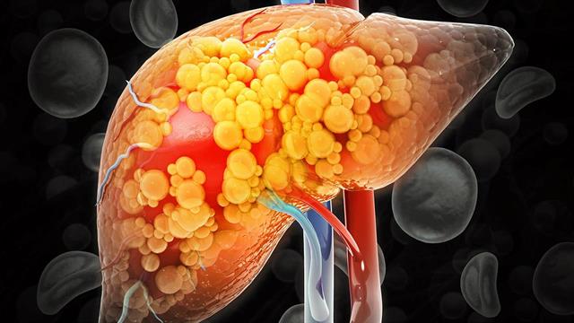 Ηπατική ίνωση: Αθέατη απειλή για τη Δημόσια Υγεία
