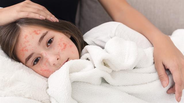 Ιλαρά: Χωρίς κρούσμα από τον περασμένο Ιούνιο η Ελλάδα - Τι γίνεται με την ερυθρά