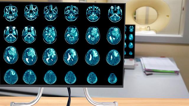 Γλοιοβλάστωμα: Η σημασία των εγκεφαλικών δικτύων στην πρόγνωση του