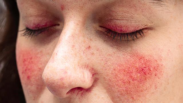 Πώς εμφανίζεται το λιπώδες ήπαρ στο πρόσωπο;