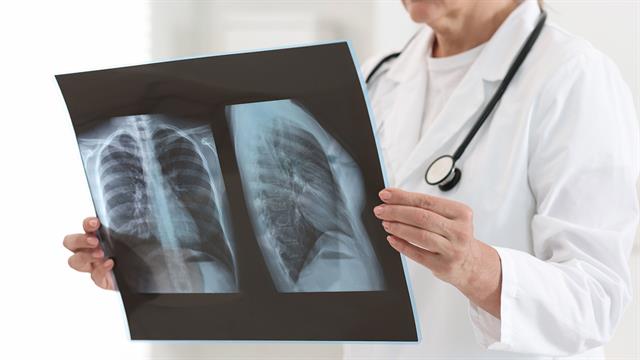 Νέα εξέταση αποκαλύπτει αδιάγνωστες μορφές φυματίωσης στις ΗΠΑ