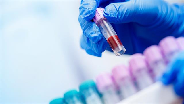 Νέα εξέταση αίματος εντοπίζει περισσότερα περιστατικά επιθετικού καρκίνου στον προστάτη [μελέτη]