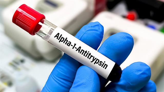 Έλλειψη άλφα-1-αντιθρυψίνης: Ερευνητές  επανεξετάζουν την ασθένεια