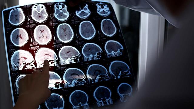 Η τεχνητή νοημοσύνη γίνεται σύμμαχος των ατόμων με Σκλήρυνση κατά Πλάκας