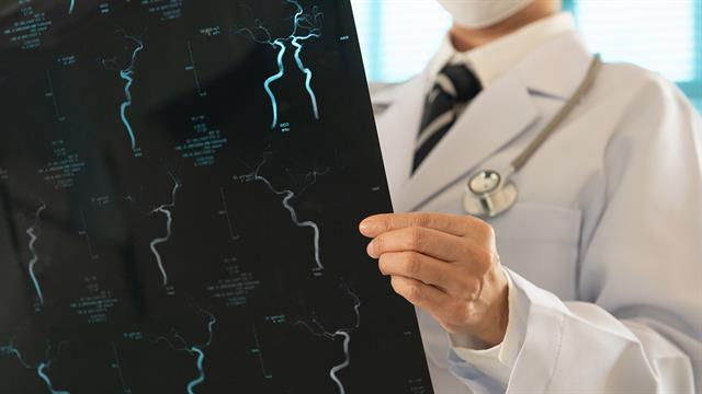 Παροδικό ισχαιμικό επεισόδιο: Αυξημένος κίνδυνος άνοιας ακόμη και δεκαετίες αργότερα