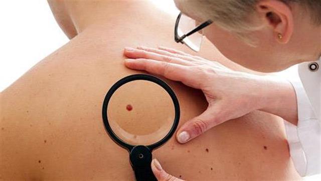 Εξελίξεις στη θεραπεία του μετασταστικού μελανώματος