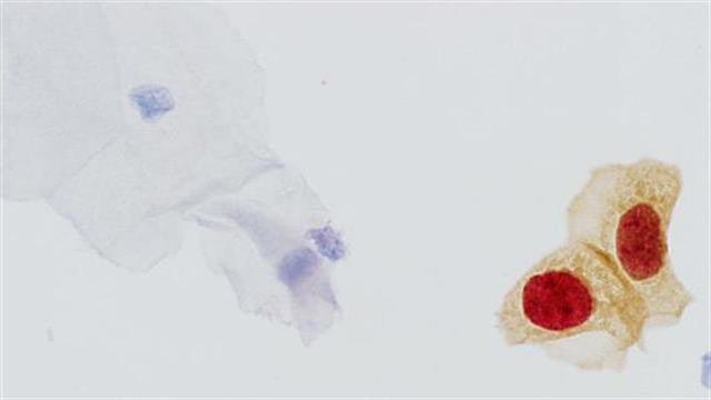 Roche: κυτταρολογικό τεστ με ευαισθησία στον καρκίνο του τραχήλου