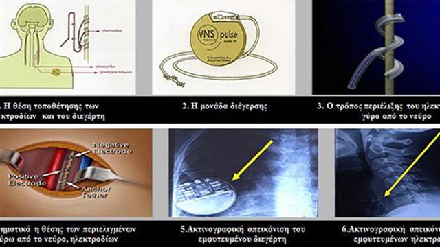 Τοποθέτηση Διεγέρτη Πνευμονογαστρικού Νεύρου για τον έλεγχο επιληπτικών κρίσεων