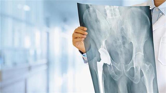 Πρωτοποριακή τεχνολογία εξομοίωσης των αρθροπλαστικών ισχίου και γόνατος βελτιώνει τις αρθροπλαστικές