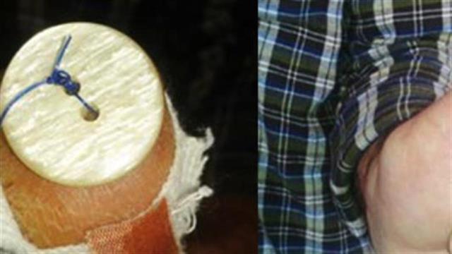 Τού έκλεισαν την πληγή, χρησιμοποιώντας κουμπί!