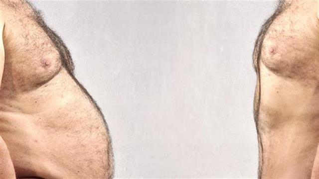Οι λιποβαρείς άνθρωποι έχουν αυξημένο κίνδυνο θνησιμότητας