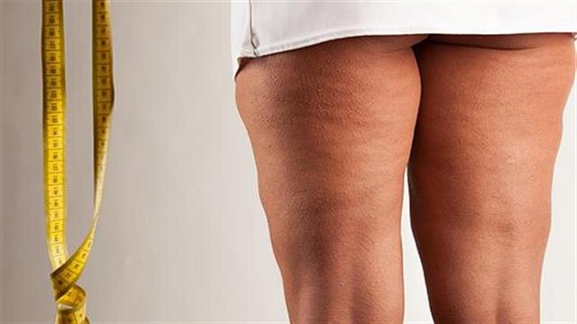 Ποιες τροφές μειώνουν την κυτταρίτιδα