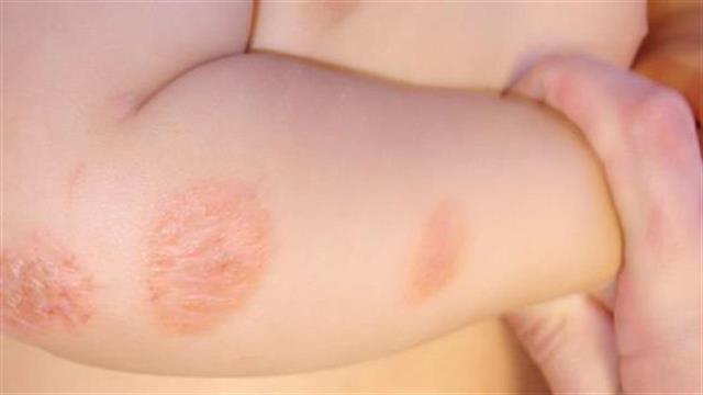 Έρευνα: Η βιταμίνη D βοηθά παιδιά με έκζεμα