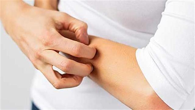 Φαύλος κύκλος η φαγούρα και το ξύσιμο