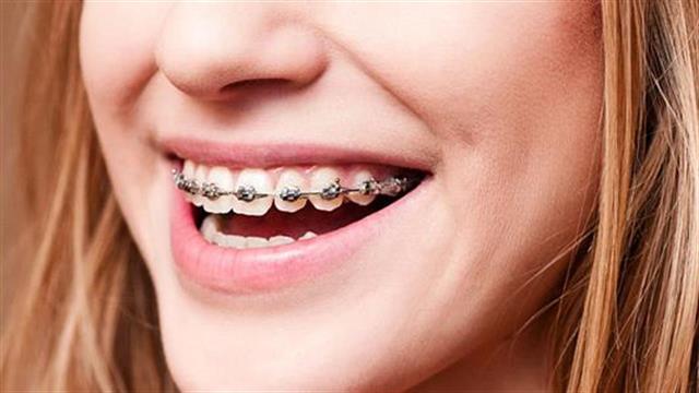 Πώς θα ισιώσω τα δόντια μου;