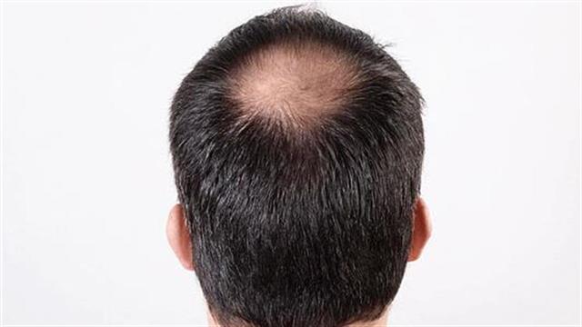 Τριχόπτωση: Ποιες παθήσεις κρύβει;