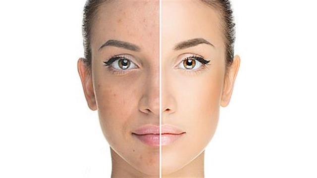 Εντοπίστηκαν γονίδια που συνδέονται με τη ροδόχρου ακμή