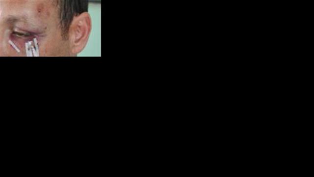 Χτύπησαν με ξύλο στο κεφάλι γιατρό στα Χανιά, επειδή...τόλμησε να υπερασπιστεί μετανάστες