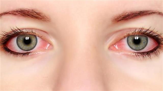 Αλλεργική επιπεφυκίτιδα: Τι πρέπει να κάνετε