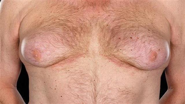 Γυναικομαστία στους άνδρες: Πώς γίνεται η θεραπεία