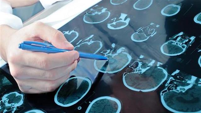 Νόσος του Parkinson: Ποια είναι τα συμπτώματα;