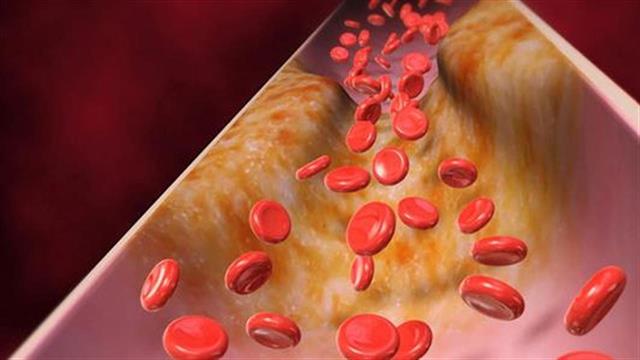 Νέα τεχνική για διάγνωση της αρτηριοσκλήρυνσης