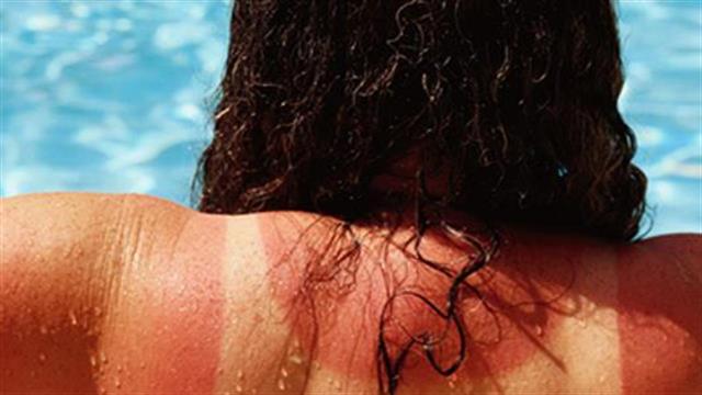 Οδηγίες για αντιμετώπιση των ηλιακών εγκαυμάτων