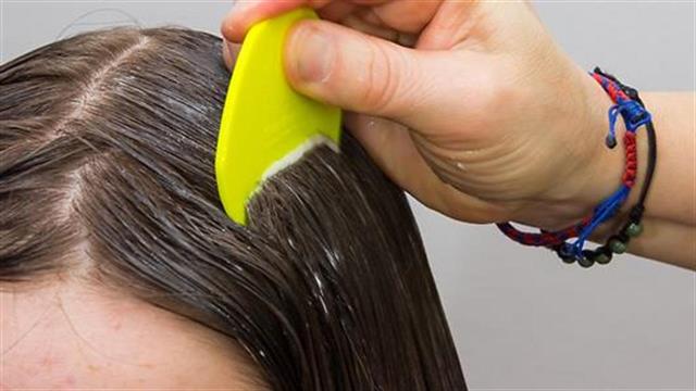 Ψείρες στα μαλλιά: Πώς αντιμετωπίζονται;