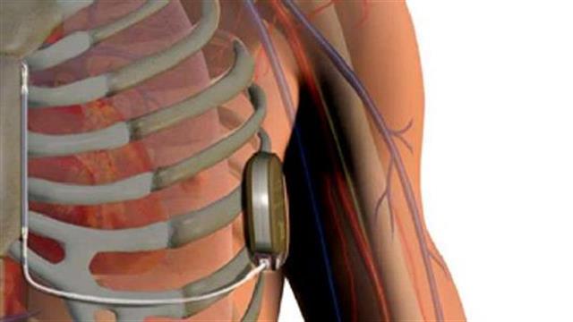 Η πρώτη εμφύτευση υποδόριου απινιδωτή στον Ευαγγελισμό