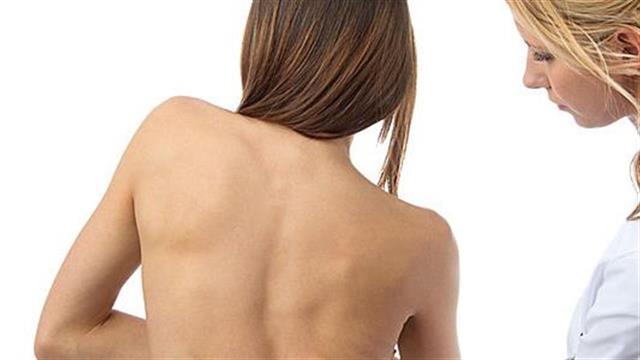 Η σκολίωση σε ενηλίκους και παιδιά