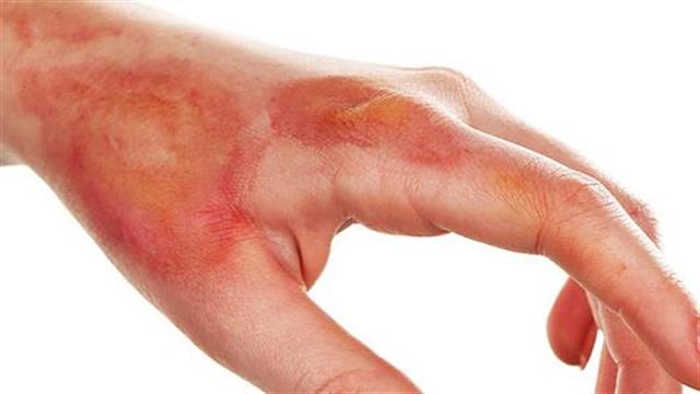 Δερματικό επίθεμα εντοπίζει λοιμώξεις