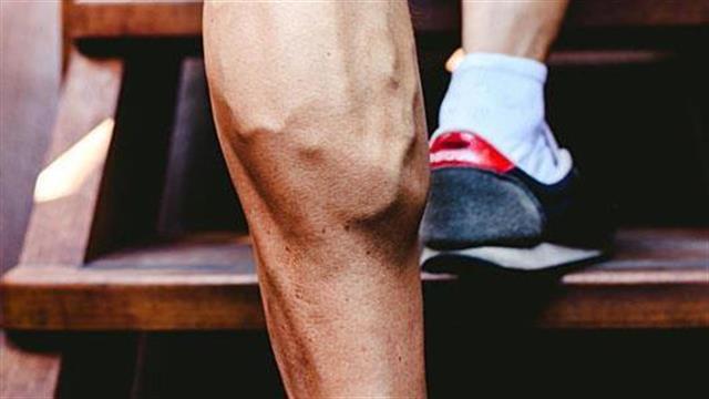 Κιρσοί - φλεβική ανεπάρκεια κάτω άκρων και εγκυμοσύνη