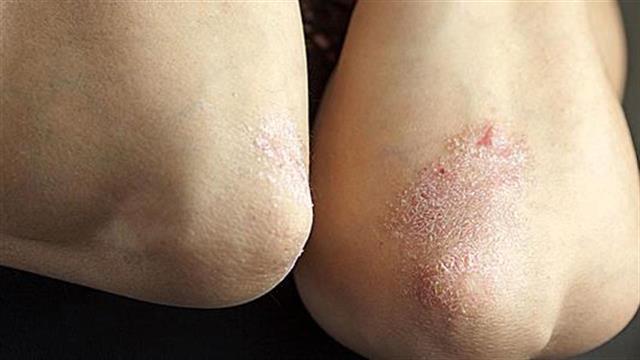 Παλεύοντας με την ψωρίαση