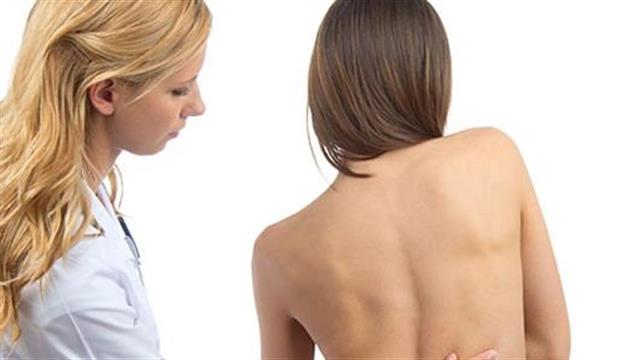 Σκολίωση: Ποια είναι η καταλληλότερη άσκηση και τι να αποφύγετε